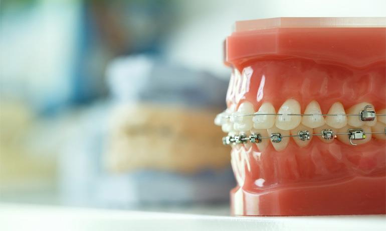 با انواع ارتودنسی دندان و مراحل آن بیشتر آشنا شوید.